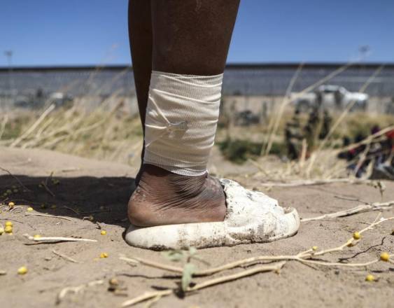 HERIKA MARTINEZ / AFP | Una mujer inmigrante con una lesión en la pierna.