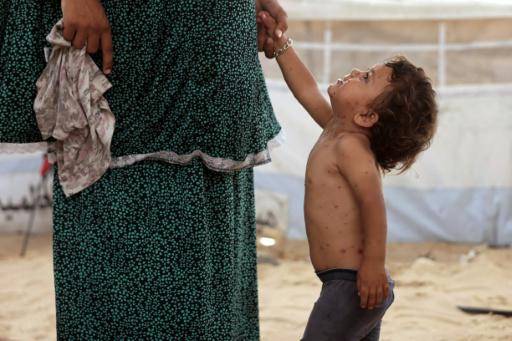 Una niña palestina con varicela toma la mano de su madre en la tienda familiar de Jan Yunis, en el sur de la Franja de Gaza, el 19 de julio de 2026