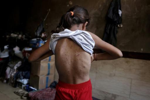 La varicela se propaga en los saturados campamentos de Gaza