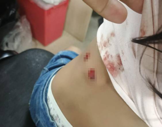 ML | Heridas supuestamente ocasionadas por la policía.