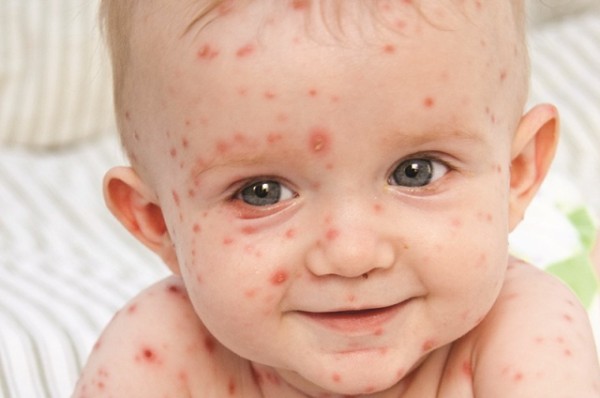 La varicela, una enfermedad que puede ser mortal