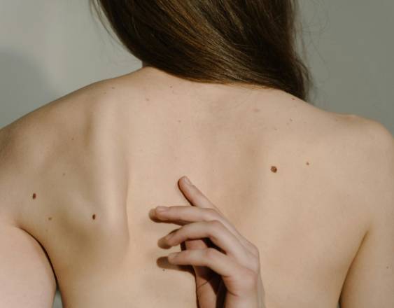 PEXELS | Una mujer con lunares.