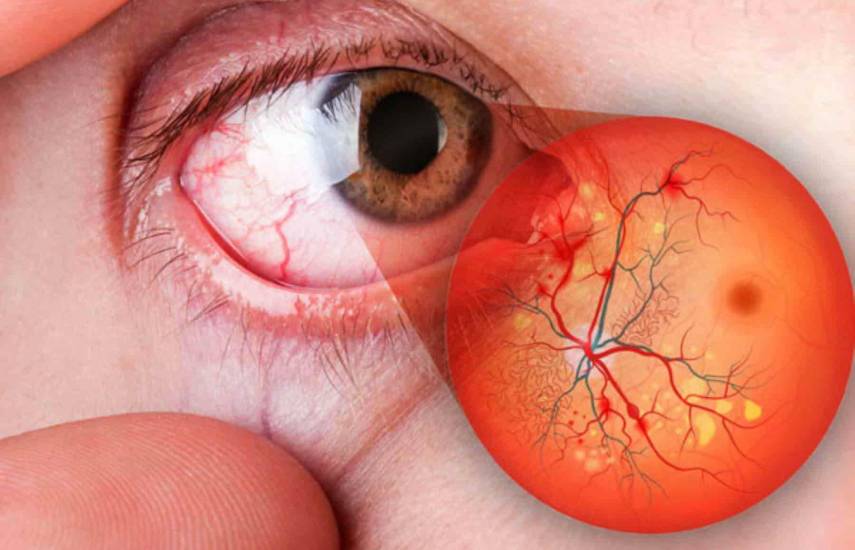 Ceguera silenciosa por la diabetes sin control