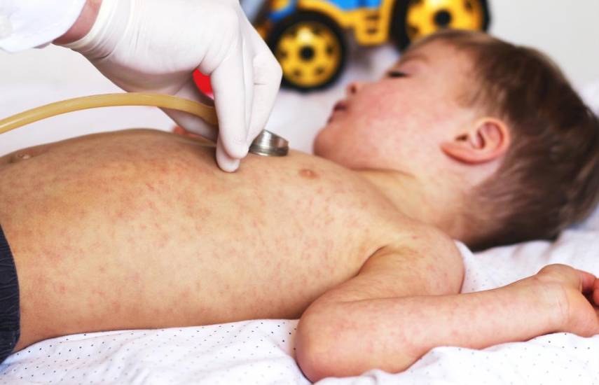 Médicos en alerta por brote de sarampión, piden a la población vacunar a los niños