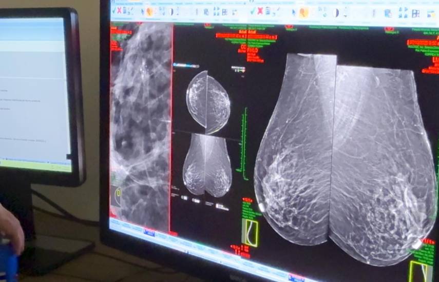50 pacientes se han beneficiado con jornadas de biopsias de mama en la Ciudad de la Salud